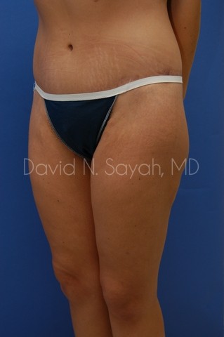Body Lift Before and After | Sayah Institute