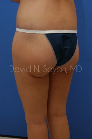 Body Lift Before and After | Sayah Institute