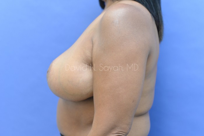 Breast Lift Before and After | Sayah Institute