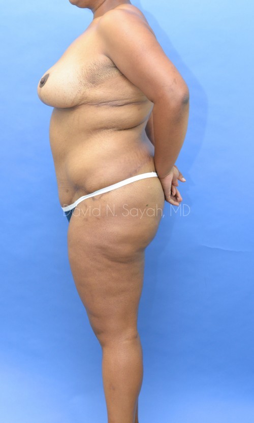 Breast Lift Before and After | Sayah Institute