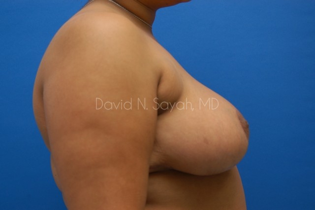 Breast Reduction Before and After | Sayah Institute