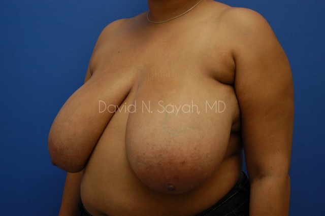 Breast Reduction Before and After | Sayah Institute