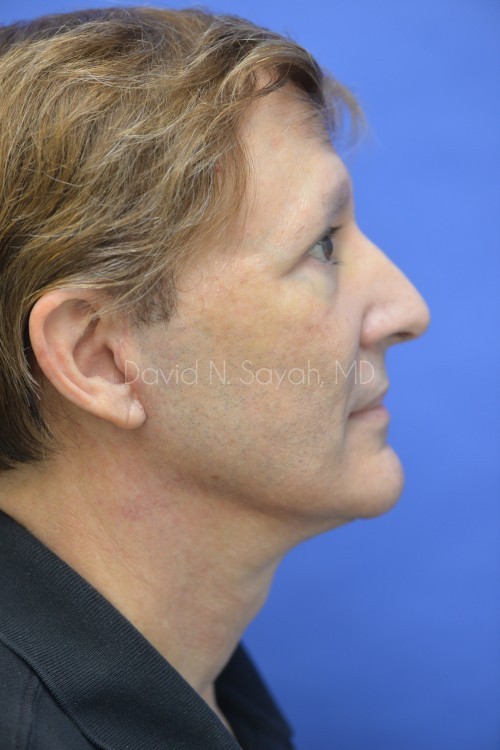 Neck Lift Before and After | Sayah Institute