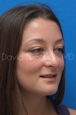 Rhinoplasty Before and After | Sayah Institute