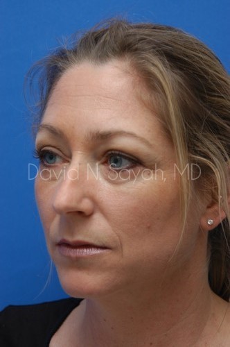 Rhinoplasty Before and After | Sayah Institute