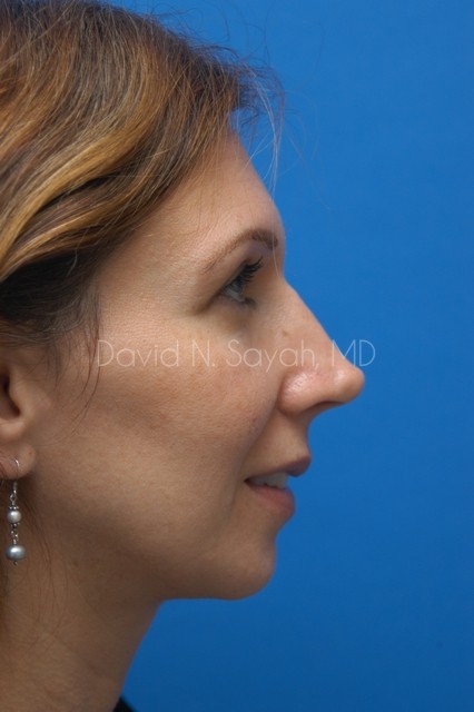 Rhinoplasty Before and After | Sayah Institute