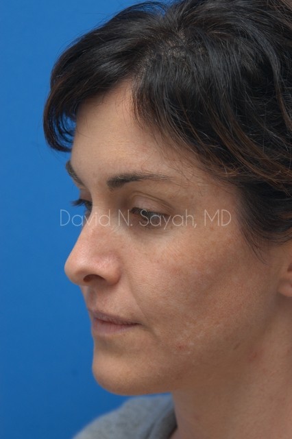 Rhinoplasty Before and After | Sayah Institute
