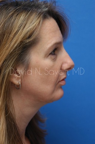 Rhinoplasty Before and After | Sayah Institute