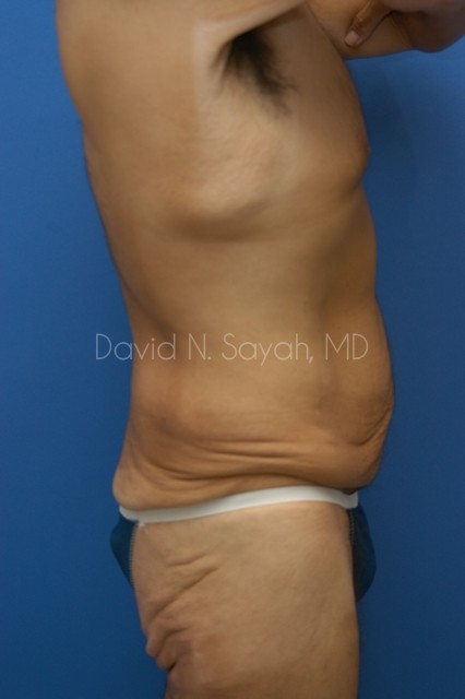 Back Tuck Belt Lipectomy Before and After | Sayah Institute