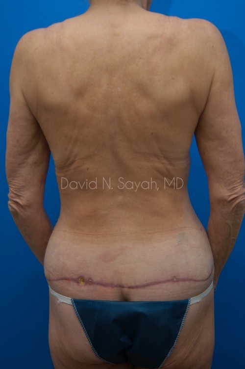 Body Lift Before and After | Sayah Institute