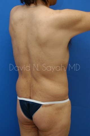 Body Lift Before and After | Sayah Institute