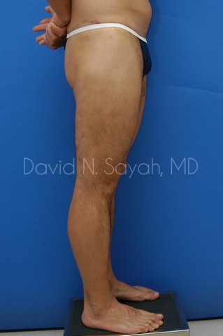 Body Lift Before and After | Sayah Institute