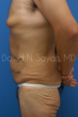 Body Lift Before and After | Sayah Institute