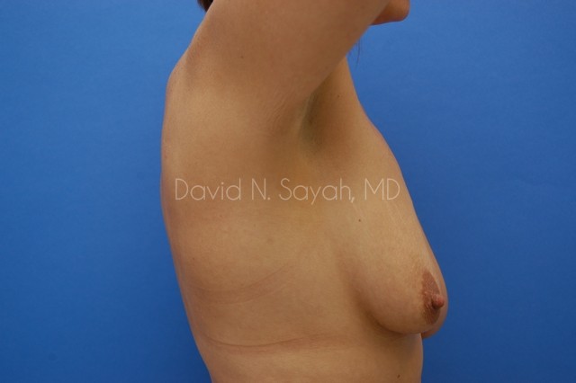 Breast Augmentation And Mastopexy Before and After | Sayah Institute