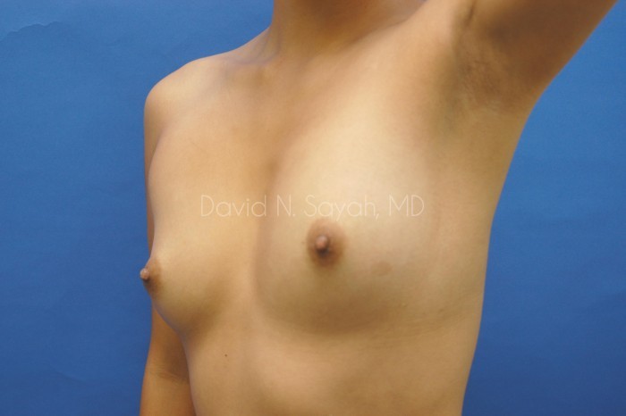 Breast Augmentation Before and After | Sayah Institute