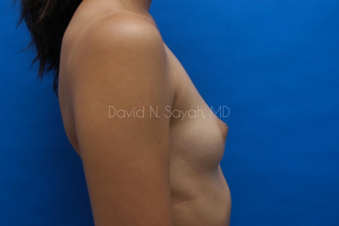 Breast Augmentation Before and After | Sayah Institute