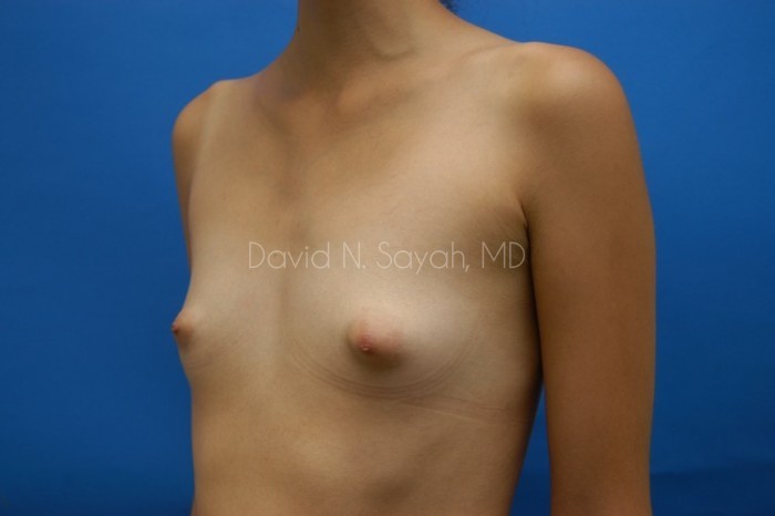 Breast Augmentation Before and After | Sayah Institute
