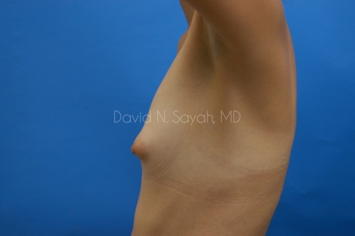 Breast Augmentation Before and After | Sayah Institute