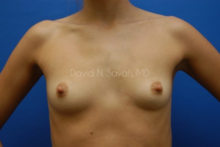 Breast Augmentation Before and After | Sayah Institute