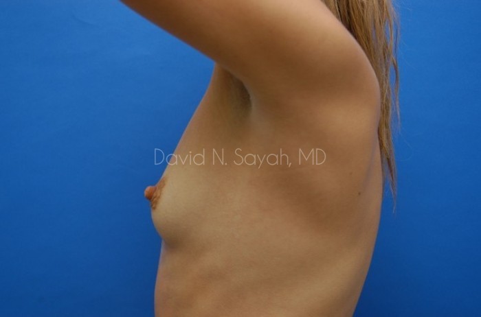 Breast Augmentation Before and After | Sayah Institute