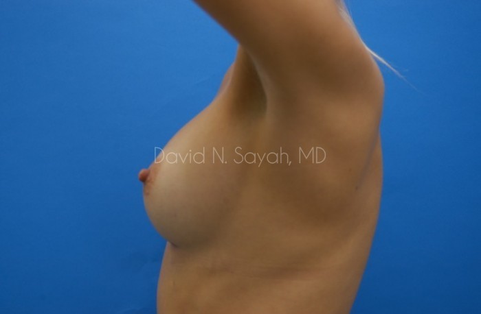Breast Augmentation Before and After | Sayah Institute