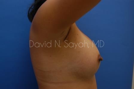 Breast Augmentation Before and After | Sayah Institute