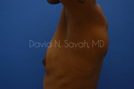 Breast Augmentation Before and After | Sayah Institute