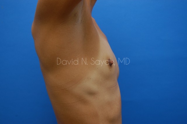 Breast Augmentation Before and After | Sayah Institute