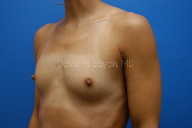 Breast Augmentation Before and After | Sayah Institute