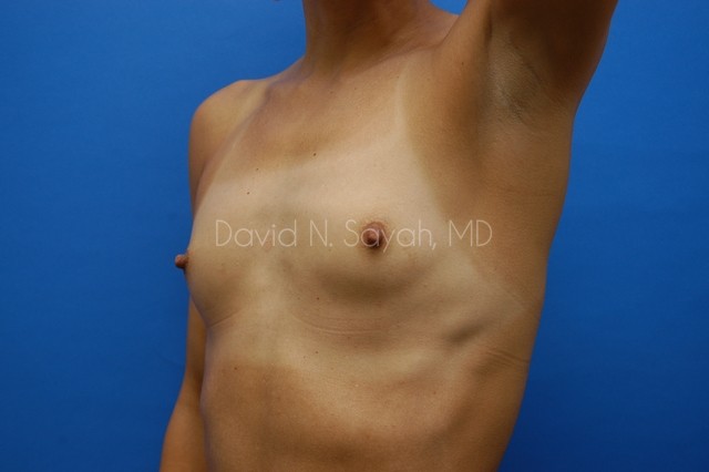 Breast Augmentation Before and After | Sayah Institute