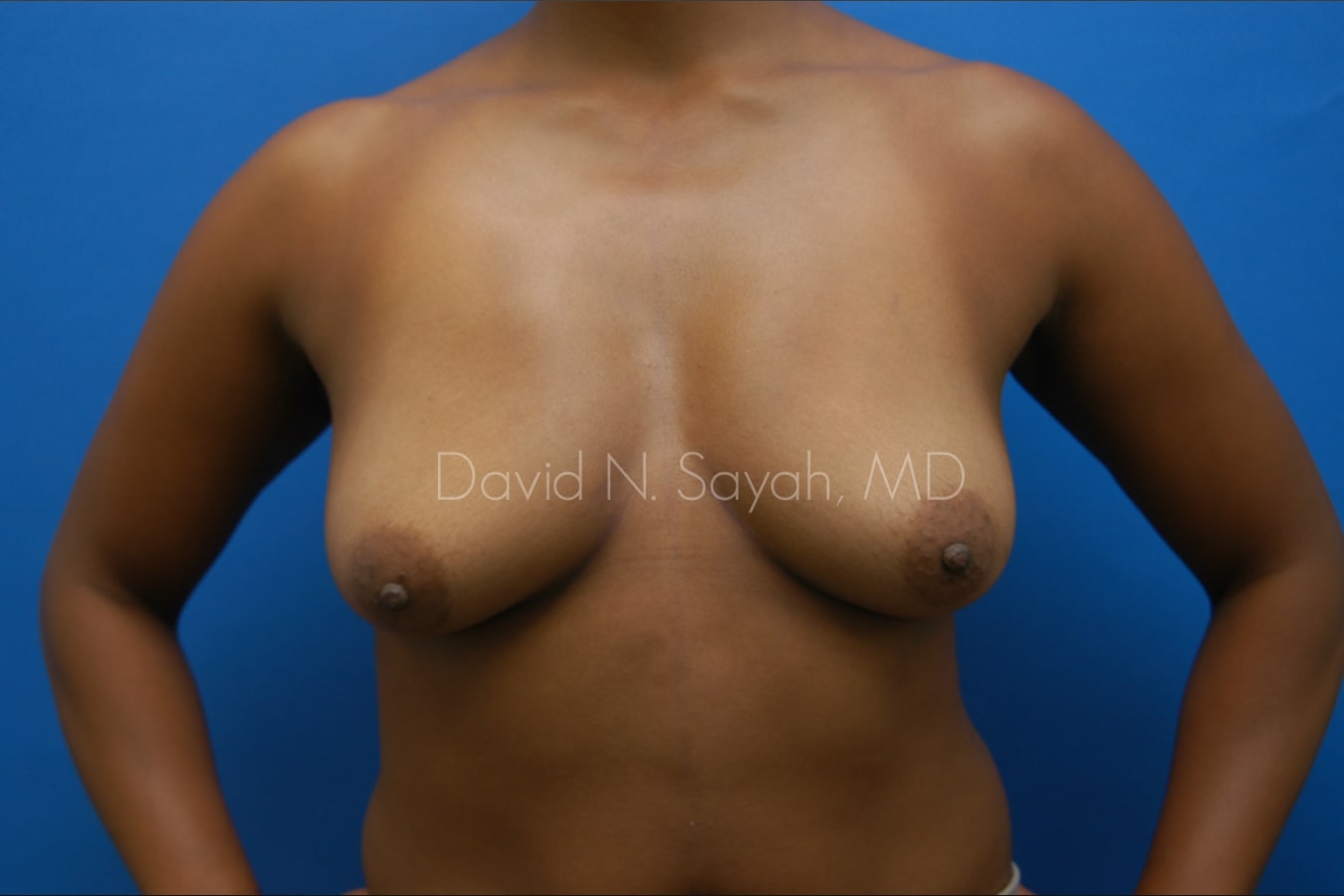 Breast Augmentation Before and After | Sayah Institute