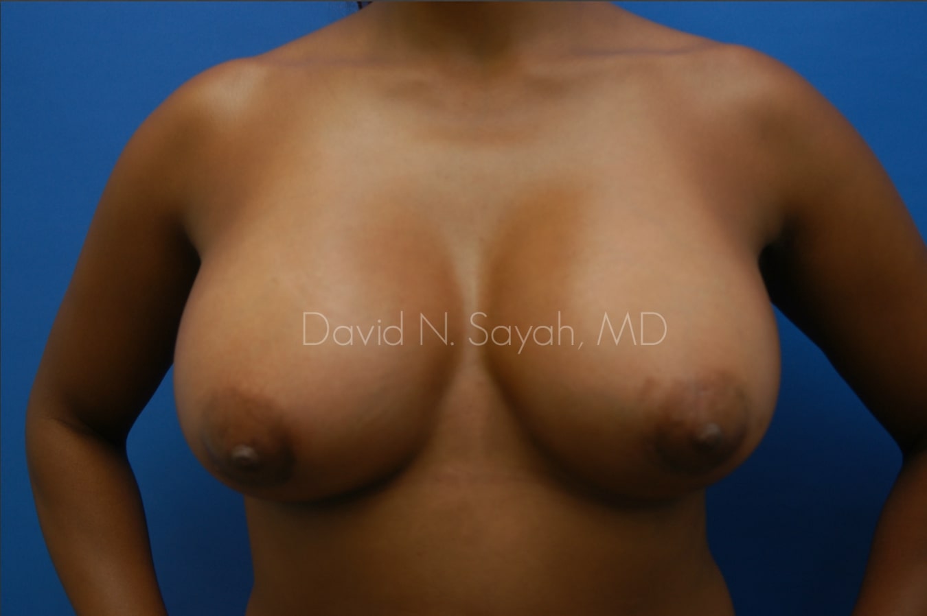 Breast Augmentation Before and After | Sayah Institute