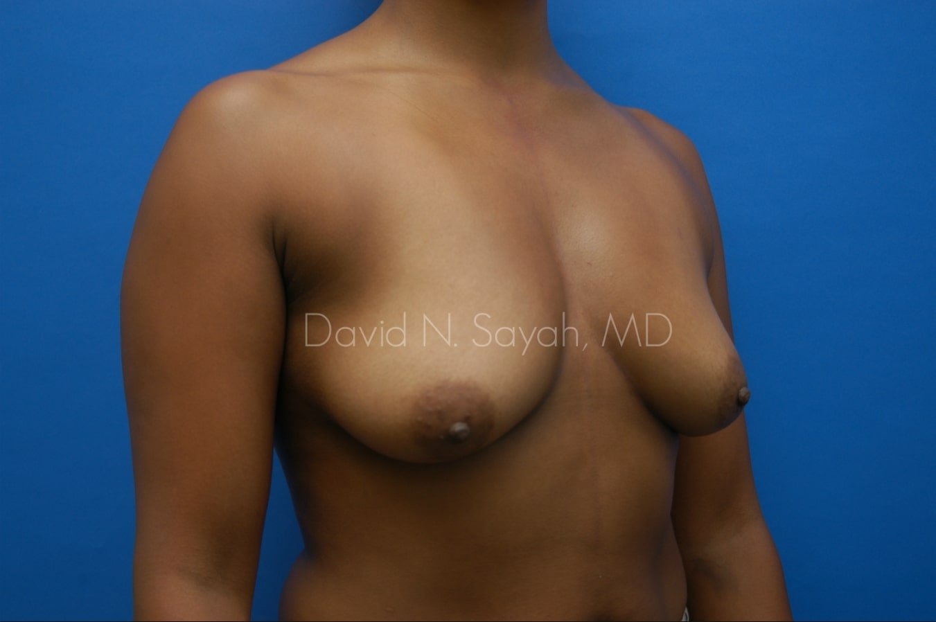 Breast Augmentation Before and After | Sayah Institute
