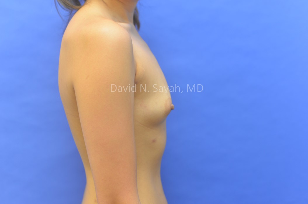 Breast Augmentation Before and After | Sayah Institute