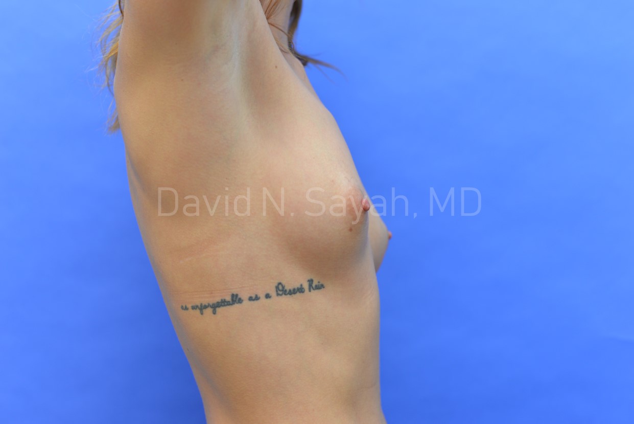 Breast Augmentation Before and After | Sayah Institute