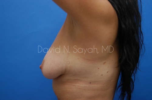 Breast Implant Exchange Before and After | Sayah Institute
