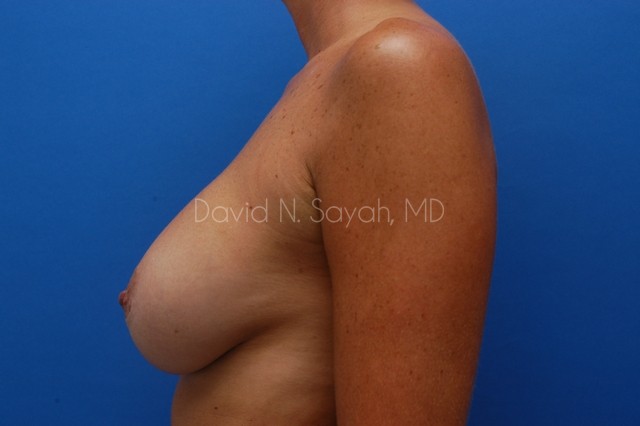 Breast Implant Exchange Before and After | Sayah Institute