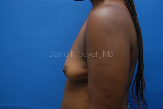 Breast Implant Exchange Before and After | Sayah Institute