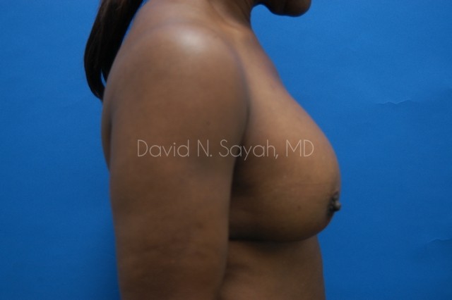 Breast Implant Exchange Before and After | Sayah Institute