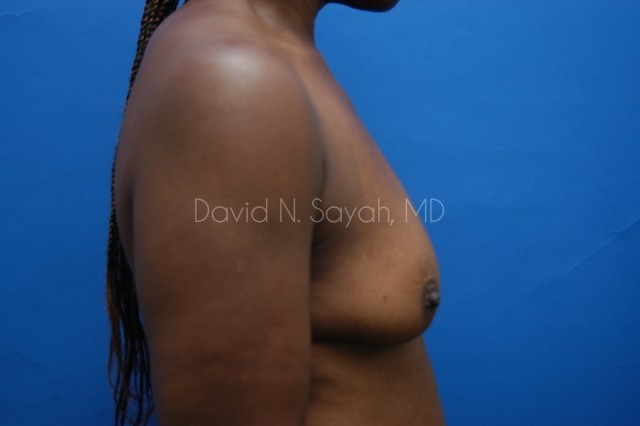Breast Implant Exchange Before and After | Sayah Institute