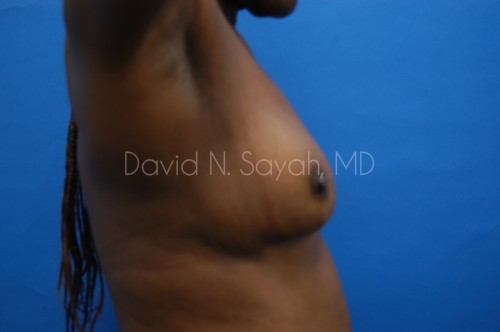 Breast Implant Exchange Before and After | Sayah Institute