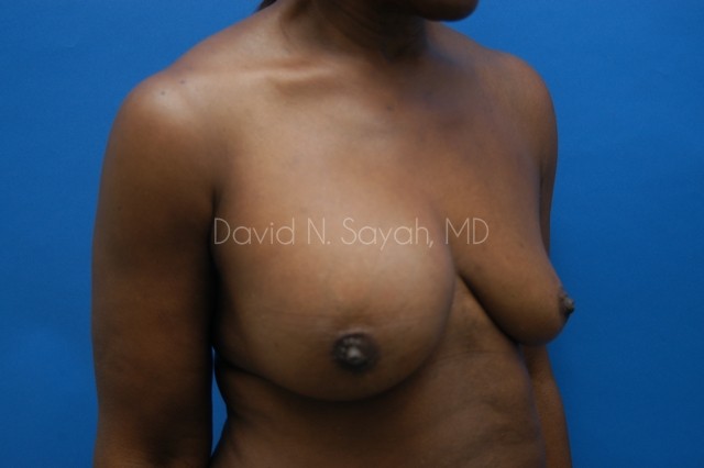 Breast Implant Exchange Before and After | Sayah Institute