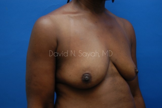 Breast Implant Exchange Before and After | Sayah Institute