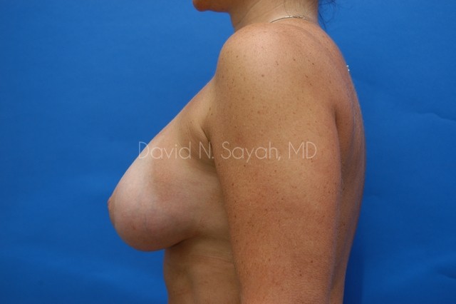 Breast Implant Exchange Before and After | Sayah Institute