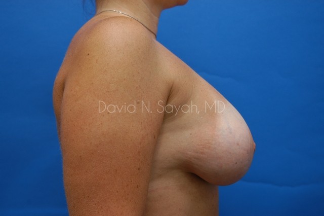 Breast Implant Exchange Before and After | Sayah Institute