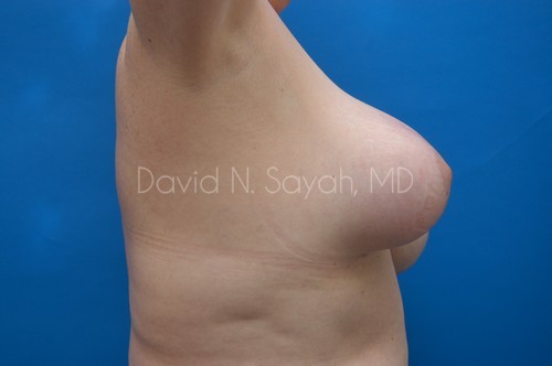 Breast Implant Exchange Before and After | Sayah Institute