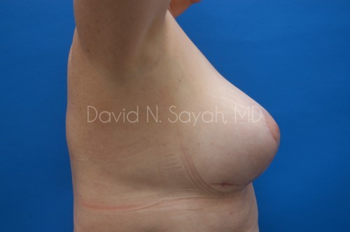 Breast Implant Exchange Before and After | Sayah Institute