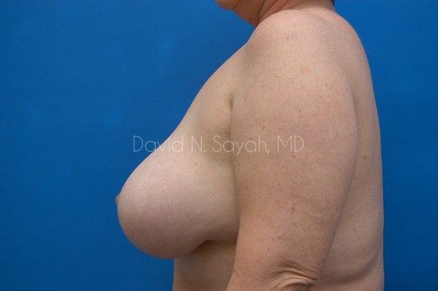 Breast Implant Exchange Before and After | Sayah Institute