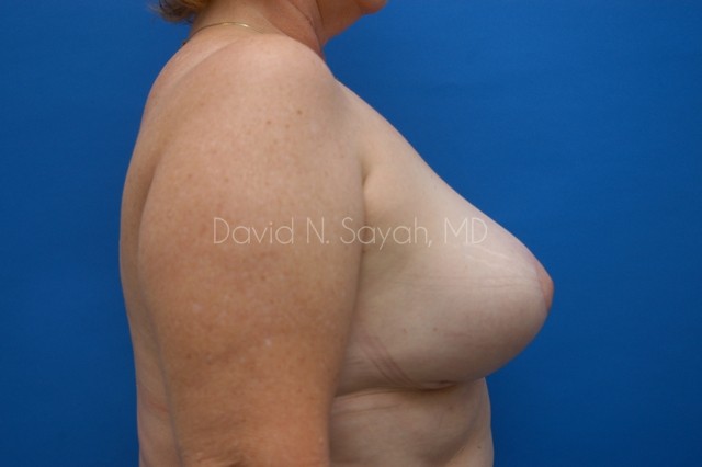 Breast Implant Exchange Before and After | Sayah Institute