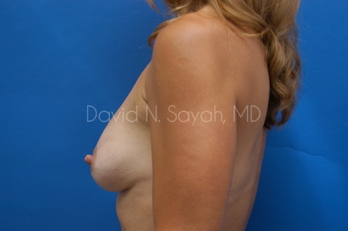 Breast Implant Revision Before and After | Sayah Institute